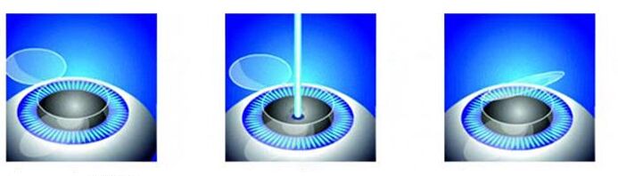Stades de la correction de la vision laser