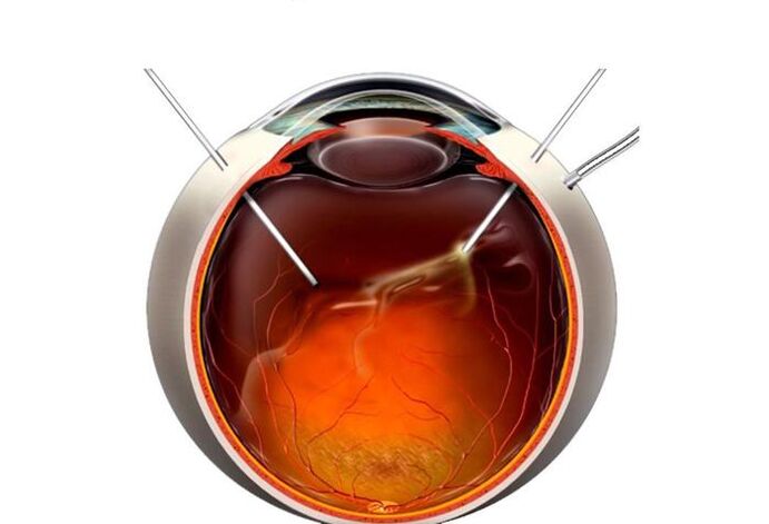 Vitrectomie - une opération pour restaurer la vue